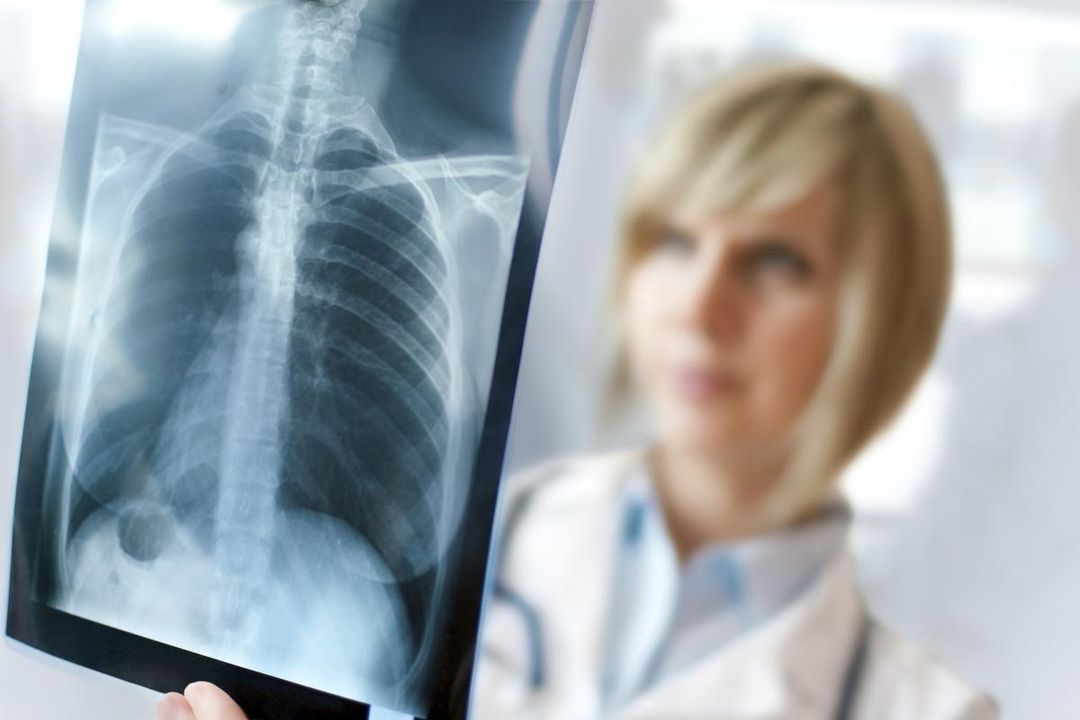 Setiap 39 Detik Satu Anak Meninggal Karena Pneumonia