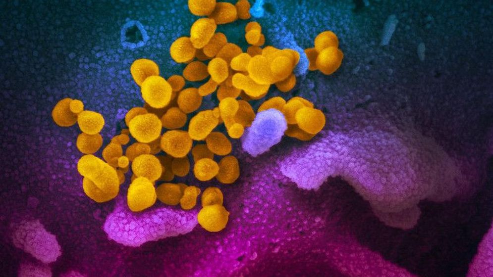 Gambar mikroskop, coronavirus baru (kuning), diantara sel manusia (biru, merah muda dan ungu)