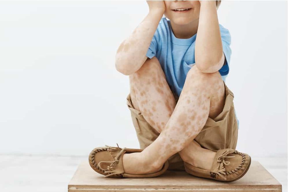 Vitiligo pada anak 