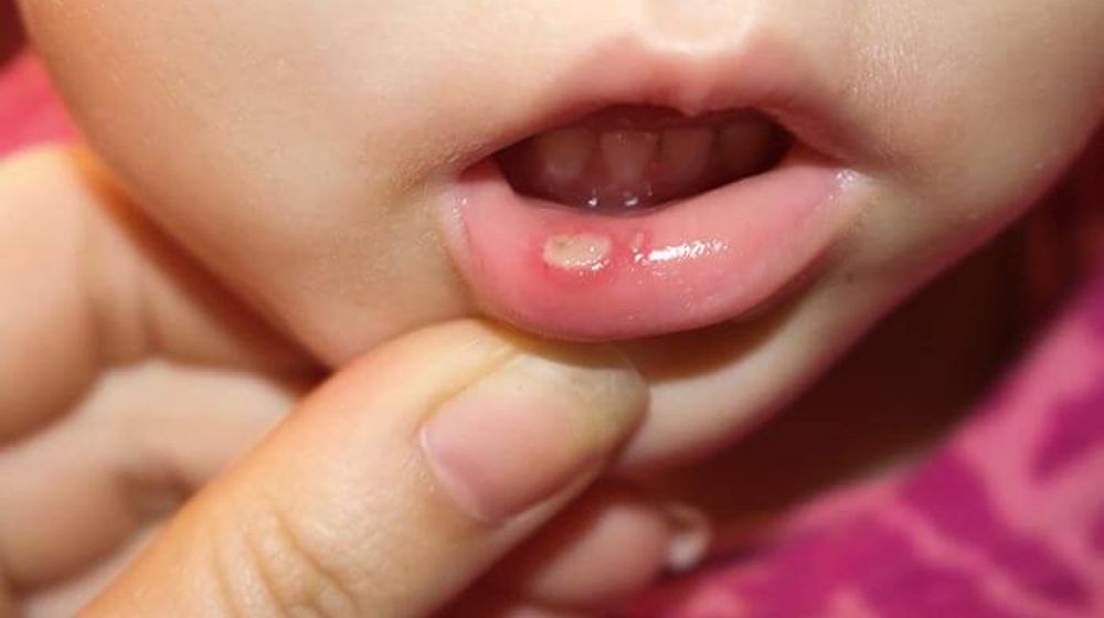 <p>Ilustrasi sariawan / Dok. Halodoc.com</p>
