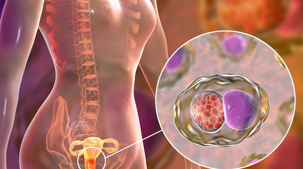 <p>Ilustrasi Kanker Serviks / Foto: Parkwaycancercentre.com</p>
