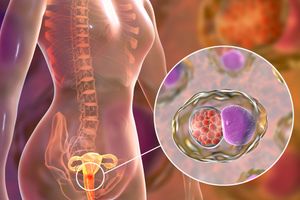 <p>Ilustrasi Kanker Serviks / Foto: Parkwaycancercentre.com</p>