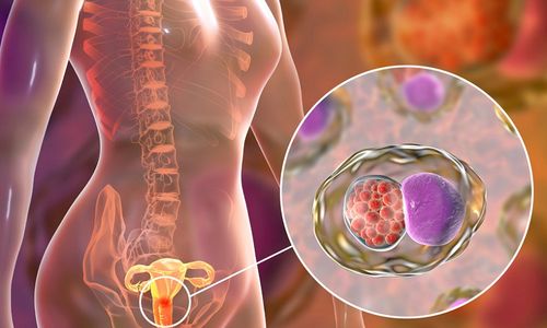 <p>Ilustrasi Kanker Serviks / Foto: Parkwaycancercentre.com</p>
