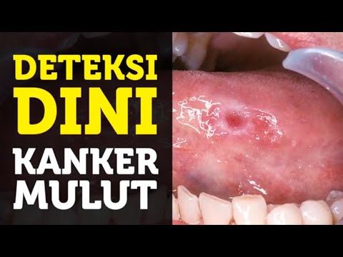 Bantu Deteksi Dini Kanker Mulut, Mahasiswa UGM Ciptakan Aplikasi Sinoma