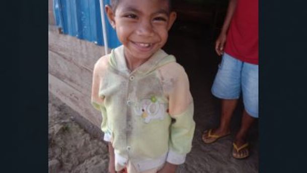 Klaudio, Bocah Stunting yang Selalu Menebar Senyum Tapi Tidak Diperhatikan oleh Pemerintah Sejak Lahir