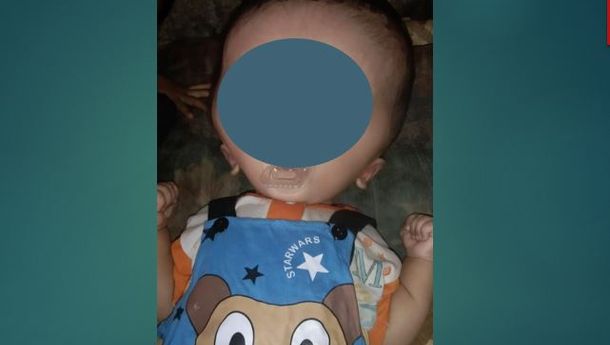 Fransiskus Chiano Mekang, Balita Penderita Alami Hidrosefalus Butuh Uluran Tangan