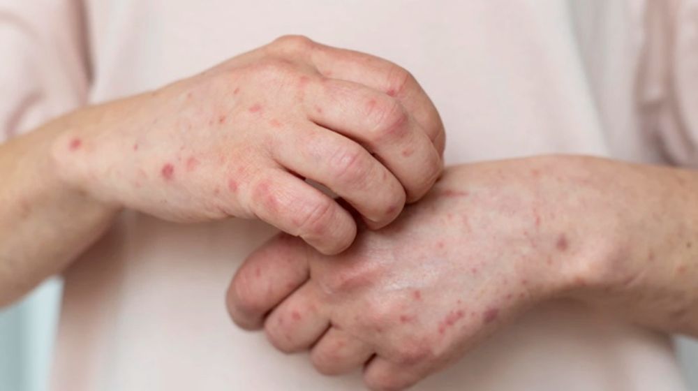 Kasus Cacar Monyet Melonjak, Ketahui Gejala dan Penyebabnya