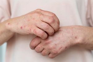 Kasus Cacar Monyet Melonjak, Ketahui Gejala dan Penyebabnya