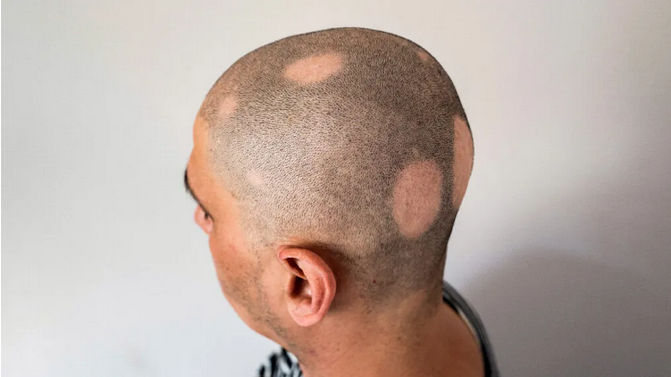 Obat baru ini berhasil menumbuhkan rambut akibat kerontokan yang disebut alopecia areata.