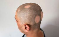 Obat baru ini berhasil menumbuhkan rambut akibat kerontokan yang disebut alopecia areata.