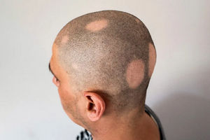 Obat baru ini berhasil menumbuhkan rambut akibat kerontokan yang disebut alopecia areata.