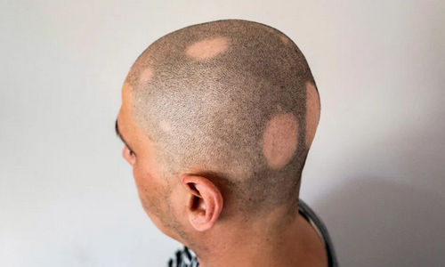 Obat baru ini berhasil menumbuhkan rambut akibat kerontokan yang disebut alopecia areata.