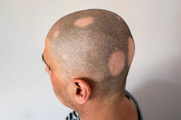 Obat baru ini berhasil menumbuhkan rambut akibat kerontokan yang disebut alopecia areata.