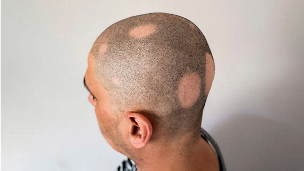 Obat baru ini berhasil menumbuhkan rambut akibat kerontokan yang disebut alopecia areata.