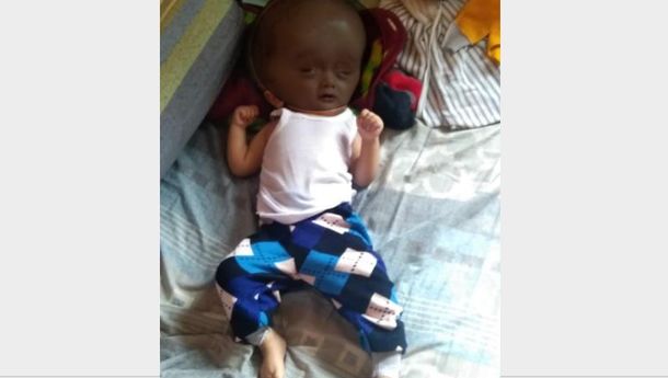 Chiano, Penderita Hidrosefalus Asal Matim Dirawat di RS Yohanes Kupang atas Bantuan Kemensos RI dan Sentra Efata