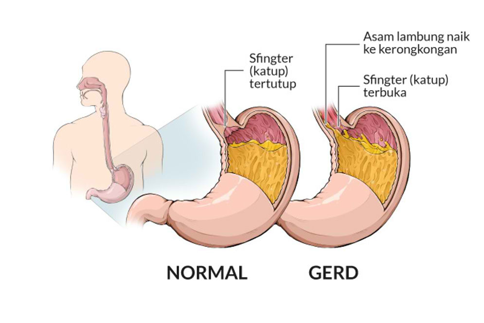 Ilustrasi kondisi lambung normal dan GERD