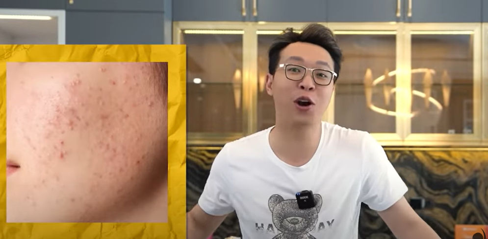 6 Penyebab Kulit Bruntusan, Dr Richard Lee Salah Satunya karena Skincare Abal-Abal