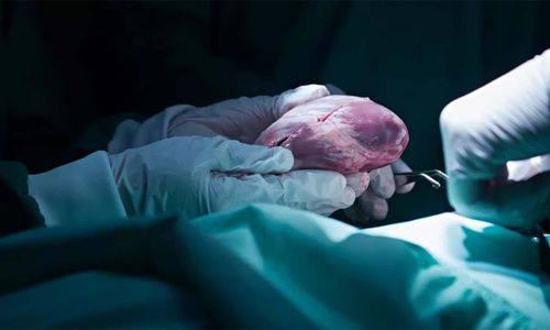 Ttransplantasi jantung.jpg