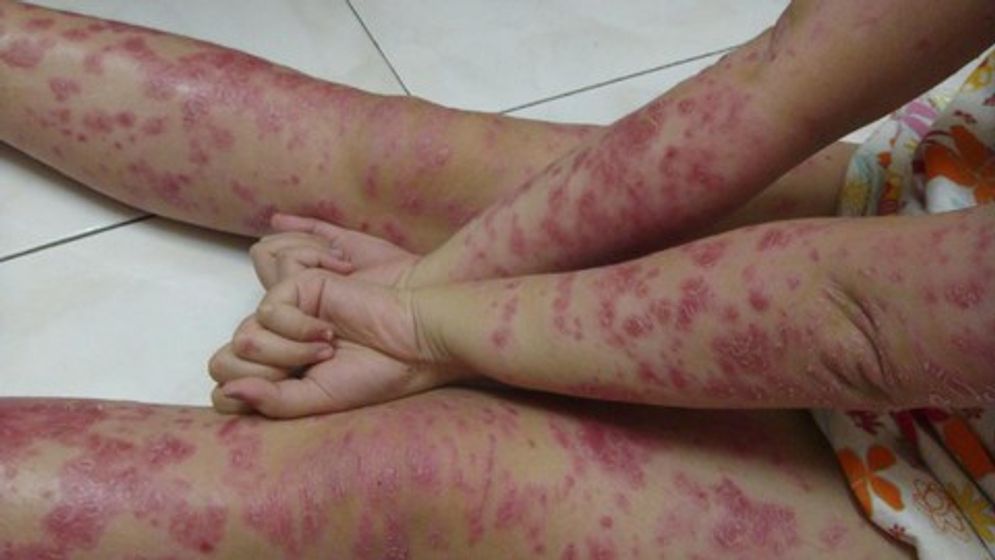 pejuang-psoriasis-3_169.jpeg