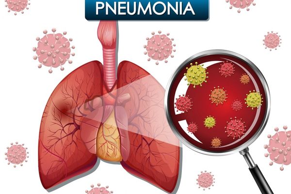 Adanya Laporan Pneumonia di China, Kemenkes Minta Semua Jajaran Kesehatan Siaga