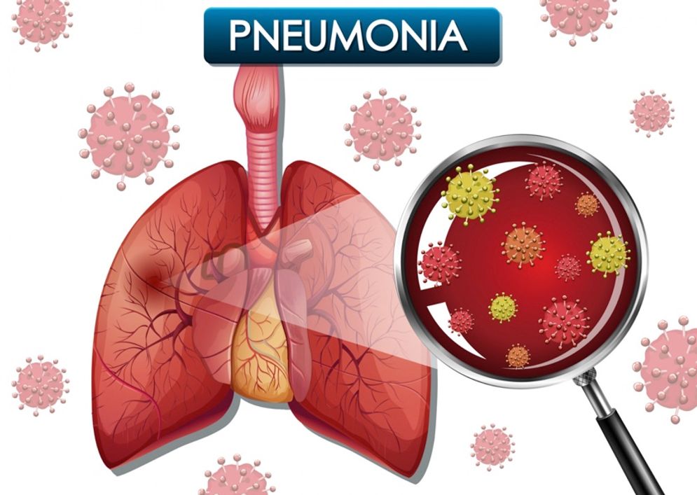 Adanya Laporan Pneumonia di China, Kemenkes Minta Semua Jajaran Kesehatan Siaga