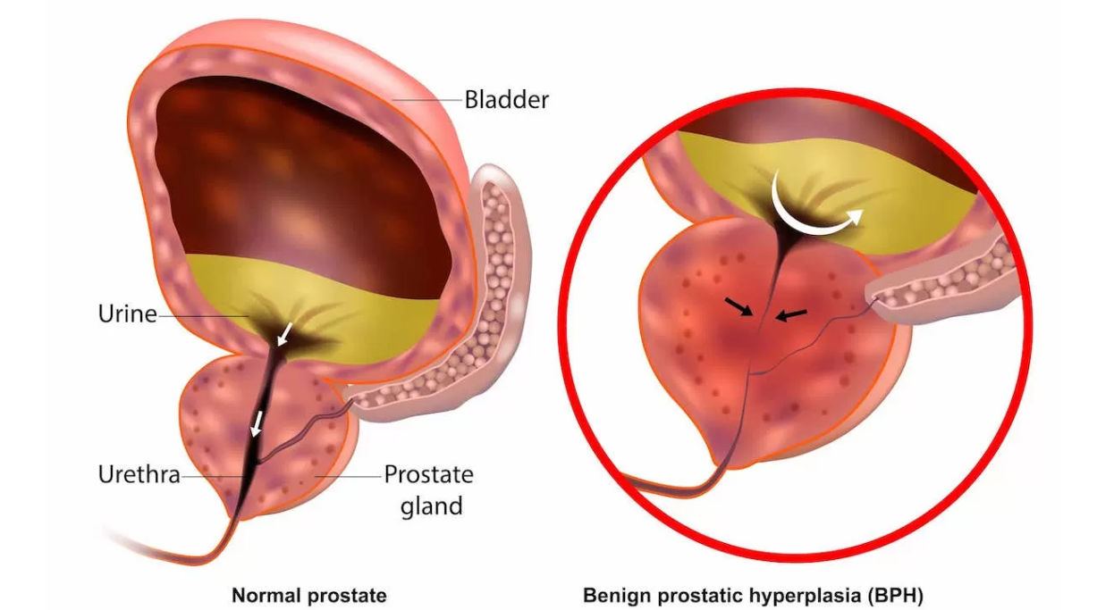 Prostat