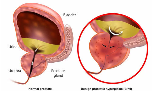 Prostat.png
