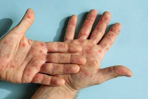 Penyakit campak pada anak