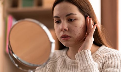 Ilustrasi wajah berjerawat.