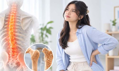 Osteoporosis Bukan Cuma untuk Lansia (1).jpg